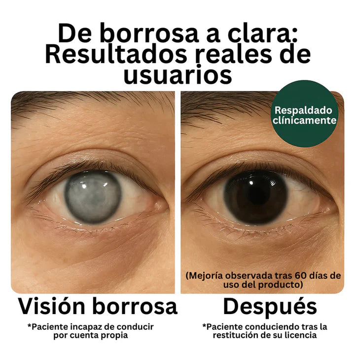 ¡Alerta de Ceguera! Detén el crecimiento del Pterigion y Recupera tu Visión Perfecta en Semanas sin Cirugías Dolorosas