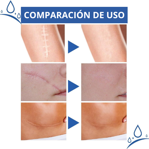 Elimina todo tipo de Cicatrices y Recupera una Piel Impecable en Solo 8 Semanas